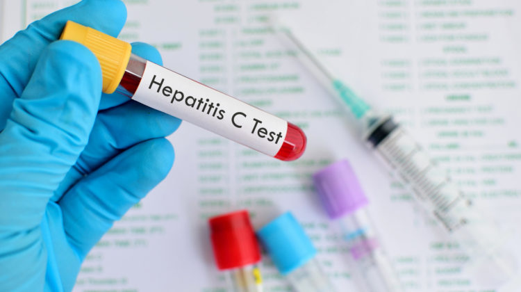 Hepatitis C Test Vorsorge Behandlungsmöglichkeiten Symptome