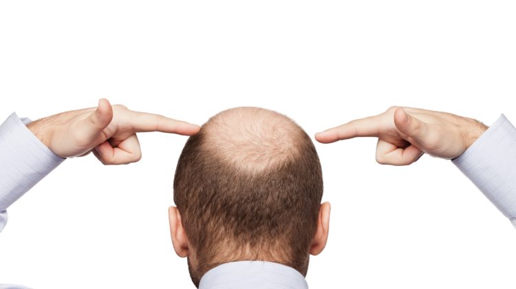 Wenn Mann Haare lässt Tipps Haarausfall Man mit Glatze 123rf